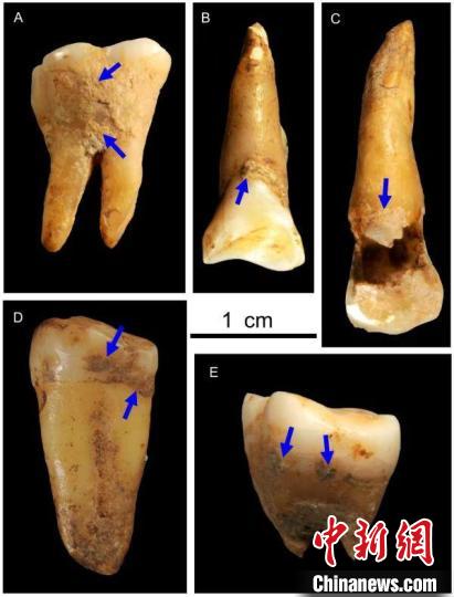 湖南道縣福巖洞8-12萬年前古人類的牙結(jié)石?！清?供圖