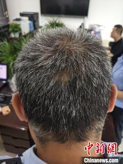 云南文山:37歲緝毒警“熬”成白頭被誤認(rèn)為是“爺爺”